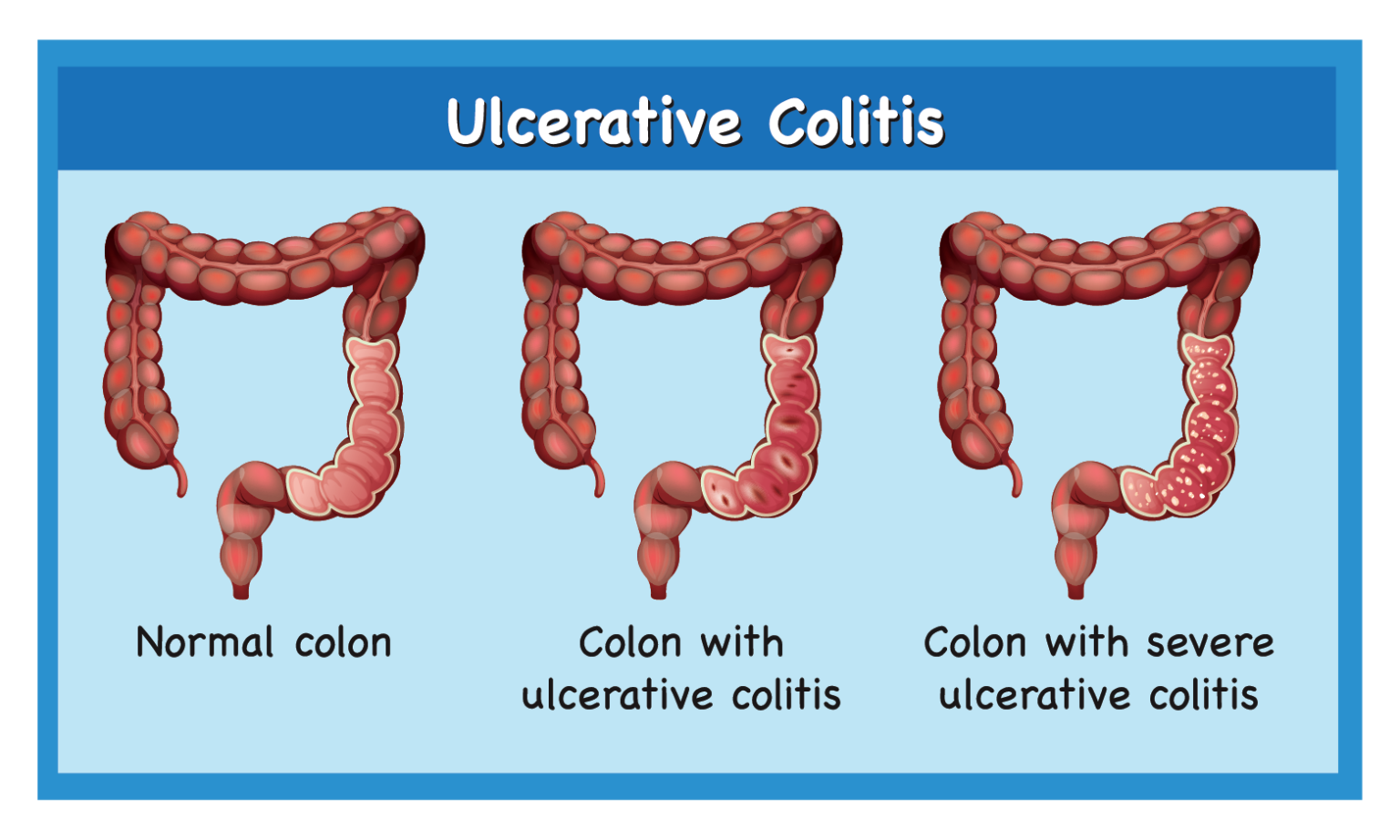 Ulcerative Colitis Diet During Flare Up