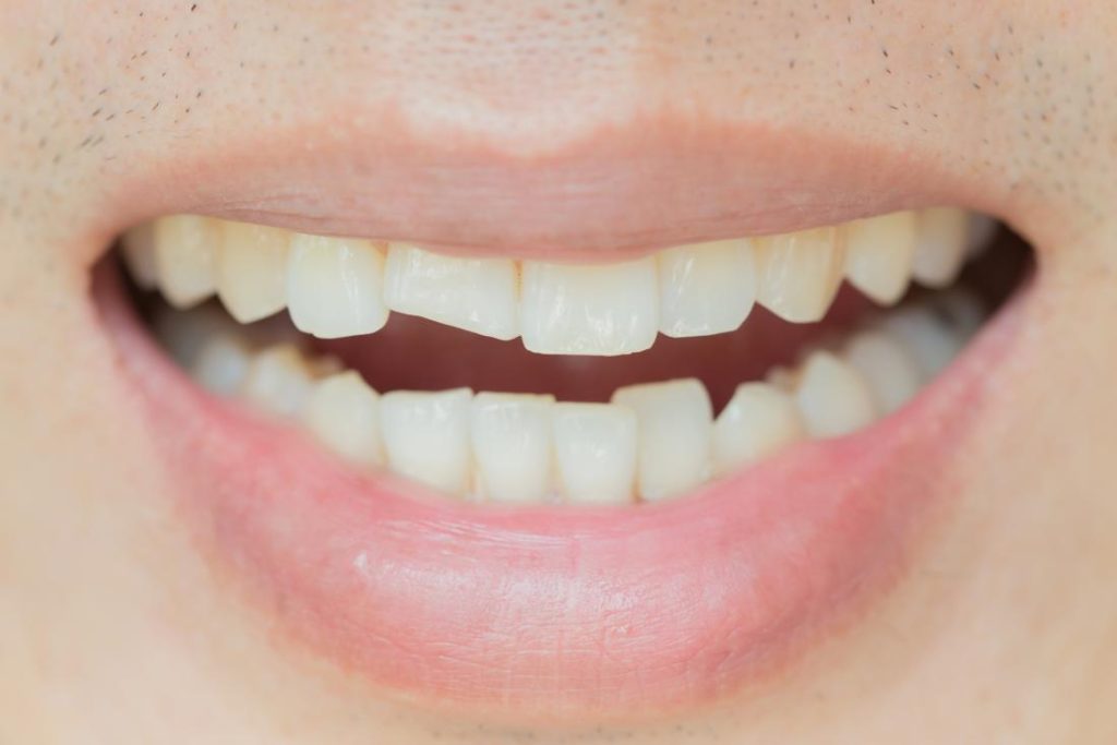 The Science Of Diagnosing A Cracked Tooth